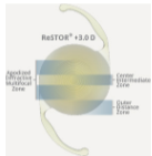 ReSTOR ® +3.0 D IOL